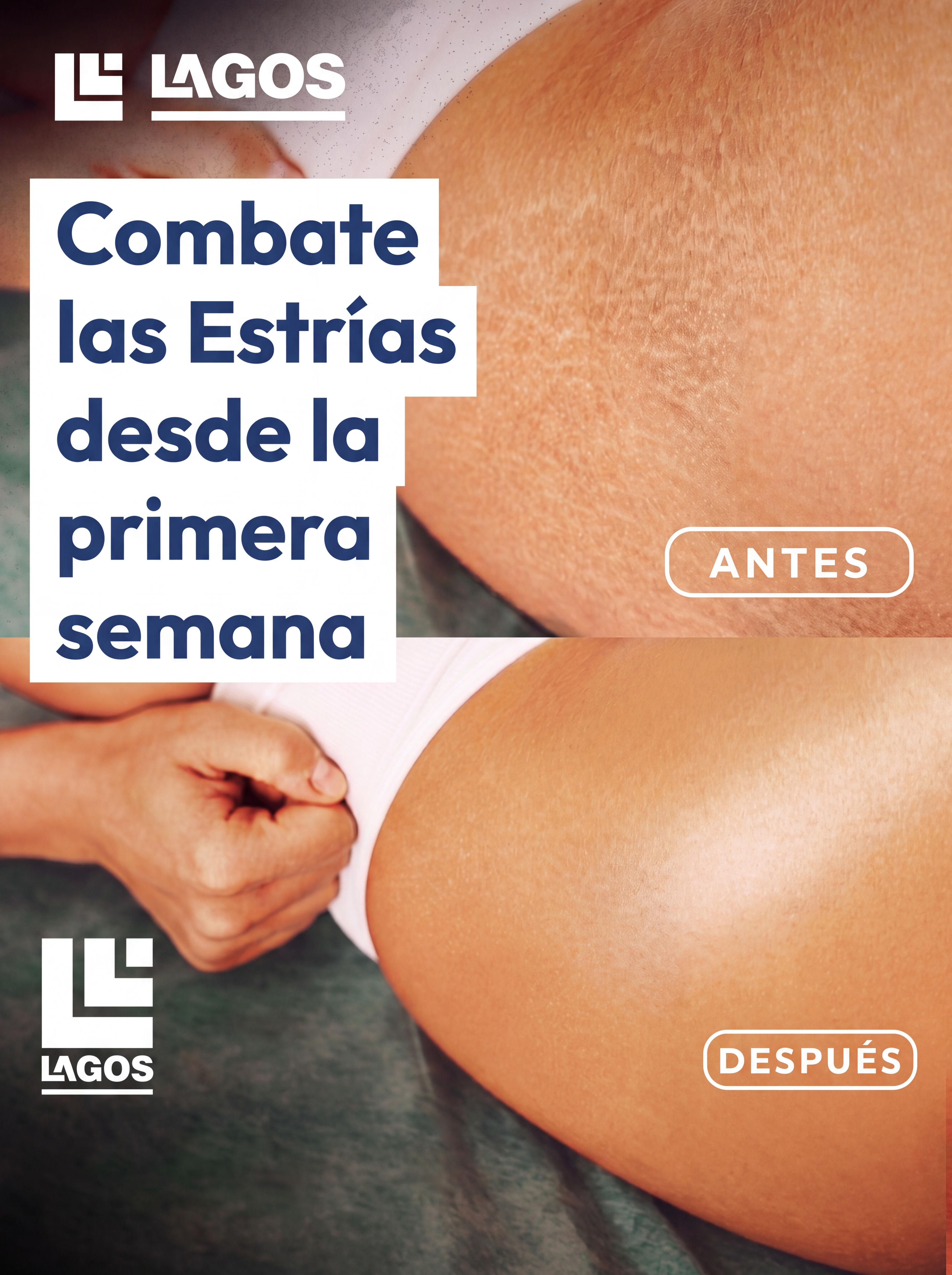 9M Crema Anti Estrias
